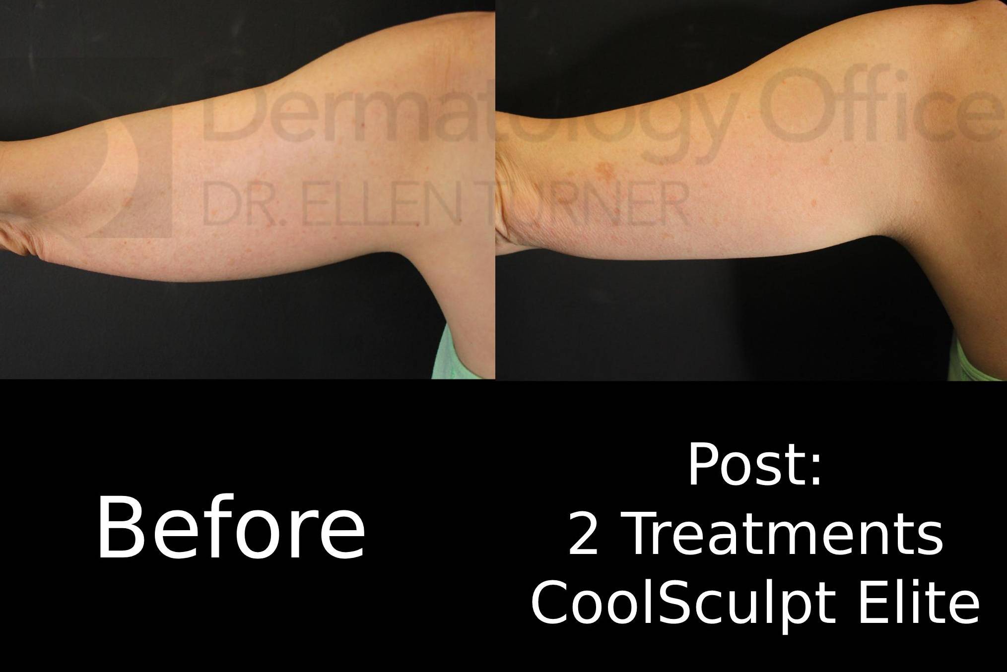 CoolSculpting Elite (2 Treatments) Case-2 