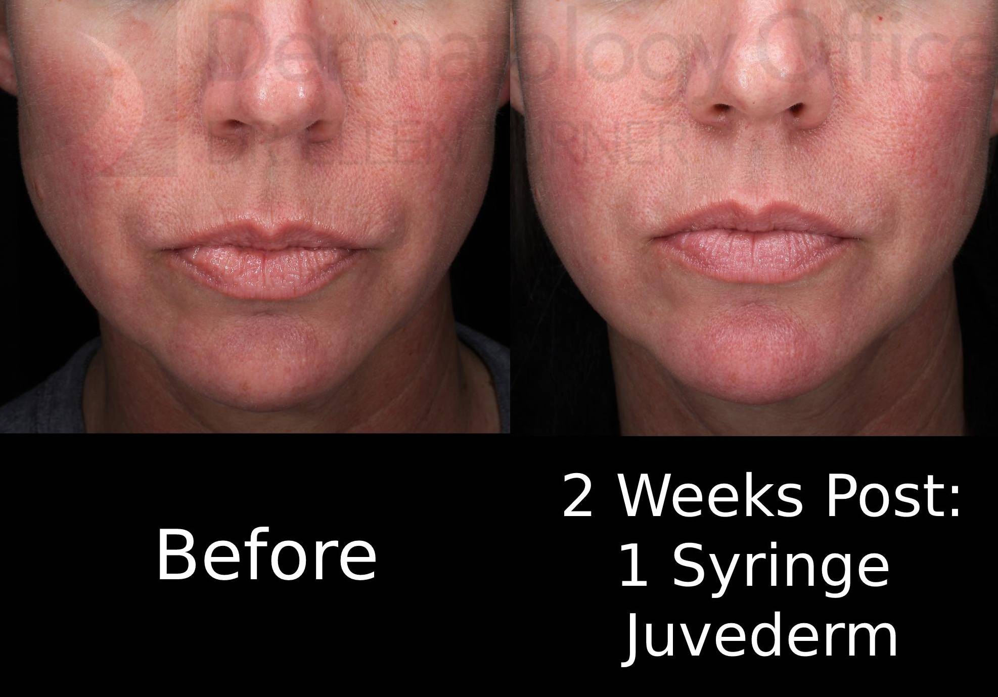 Juvederm (1 Syringe) Case-19 