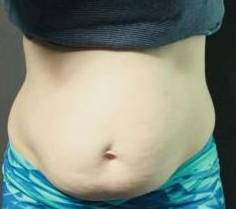 CoolSculpting<sup>®</sup> Before and After Case 10 Before