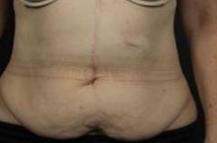 CoolSculpting<sup>®</sup> Before and After Case 11 Before