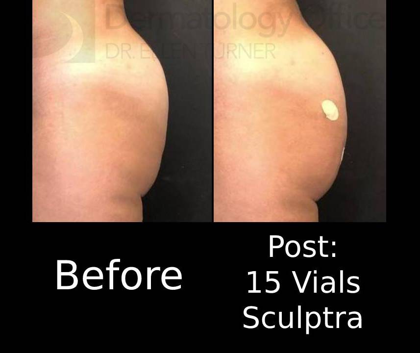 Sculptra (15 Vials) Case 1 