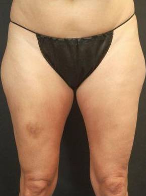 CoolSculpting<sup>®</sup> Before and After Case 12 Before