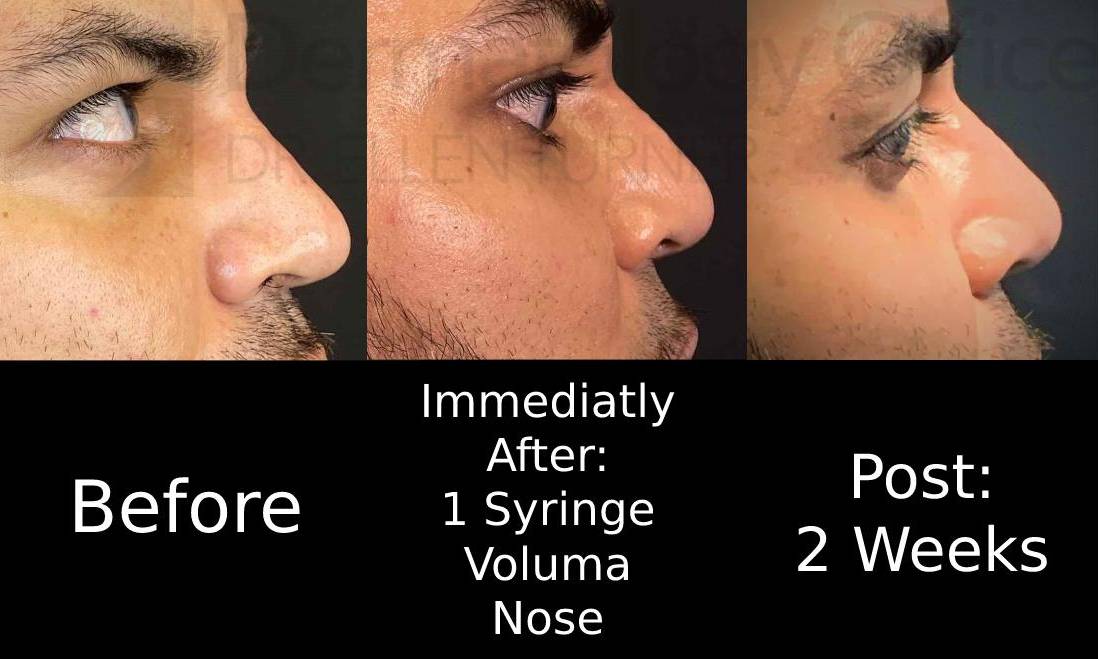 Voluma (1 Syringe) Case-9 