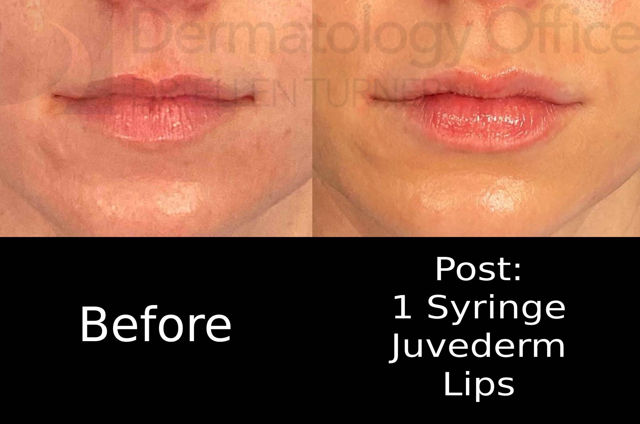 Juvederm (1 Syringe) Case-20 
