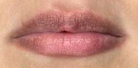 Juvederm (2 Syringes) Case-3 Before