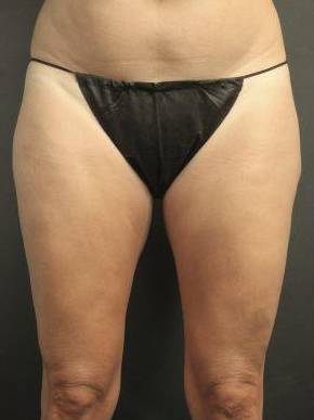 CoolSculpting<sup>®</sup> Before and After Case 12 After