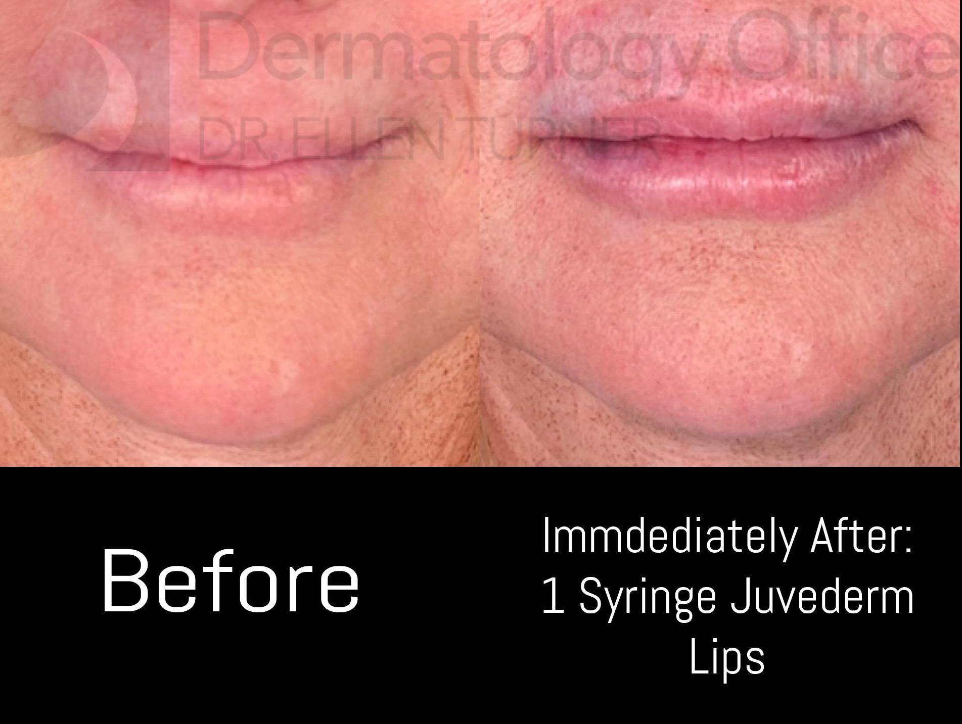 Juvederm (1 Syringe) Case-22 