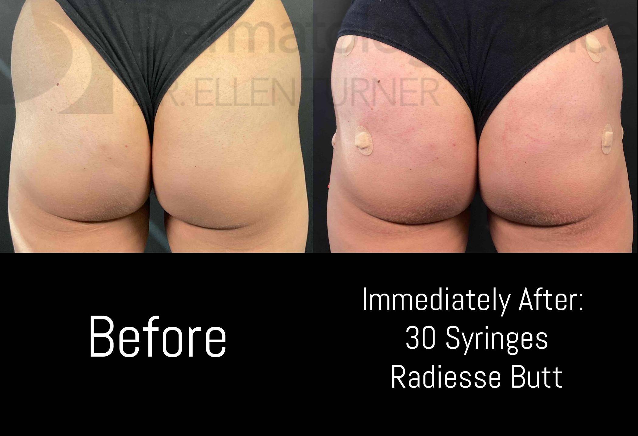 Radiesse (30 syringes) Case-11 