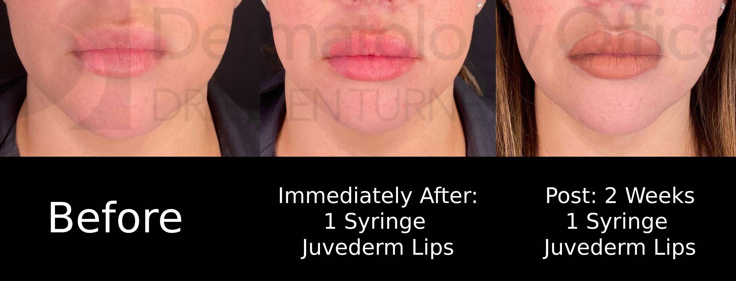 Juvederm (1 Syringe) Case-23 