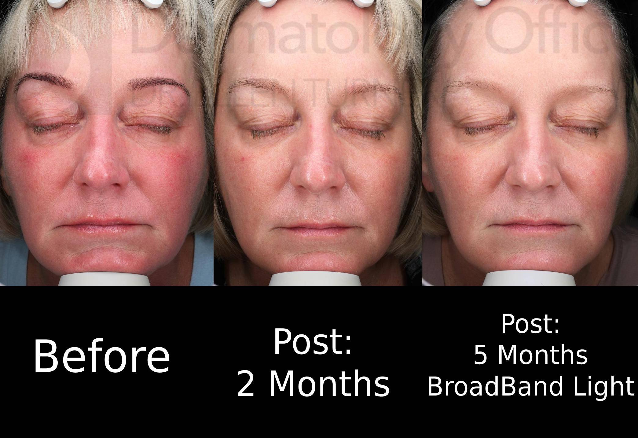IPL-Photofacial/BBL BroadBand Laser Case-11 