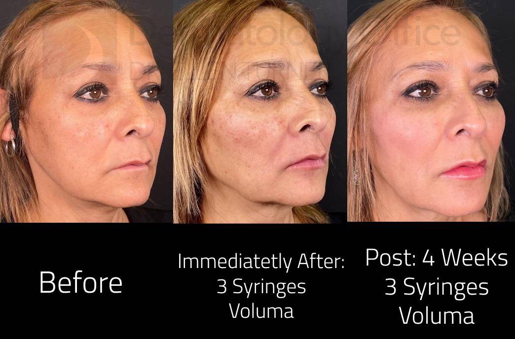 Voluma (3 Syringes) Case-8 