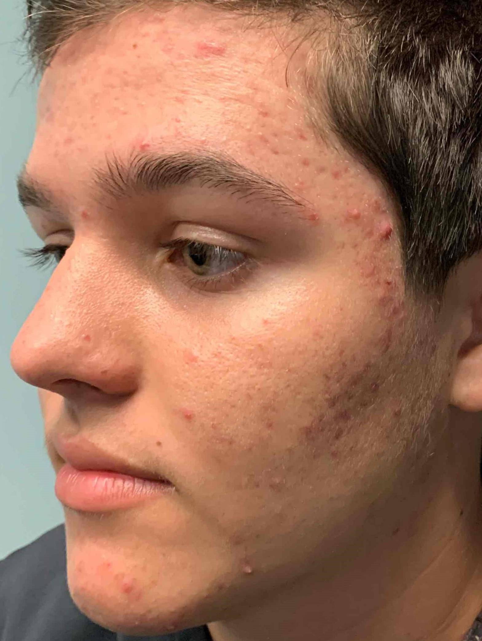 Acne (5 Month Accutane) Case 18 Before