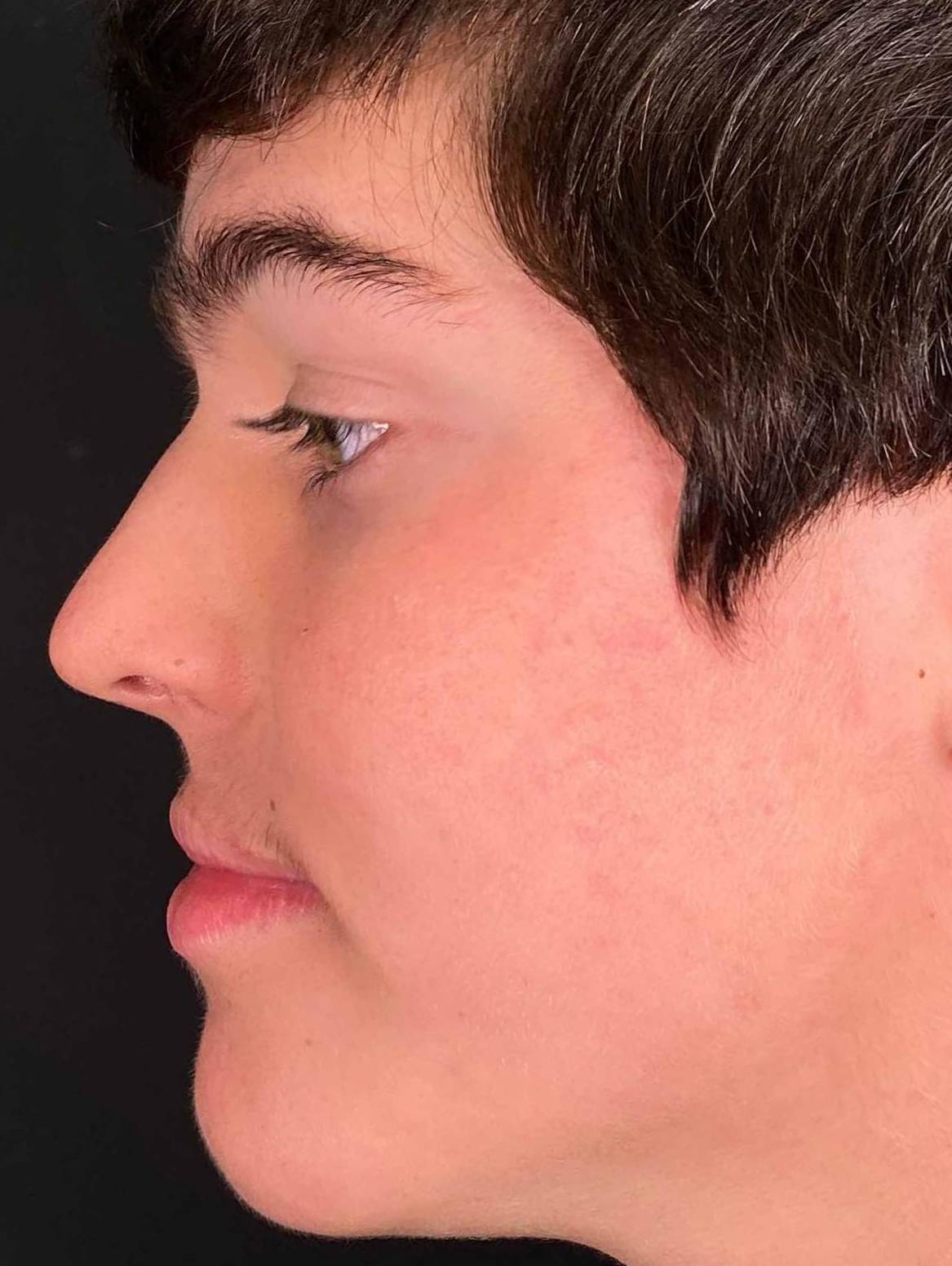 Acne (5 Month Accutane) Case 18 After