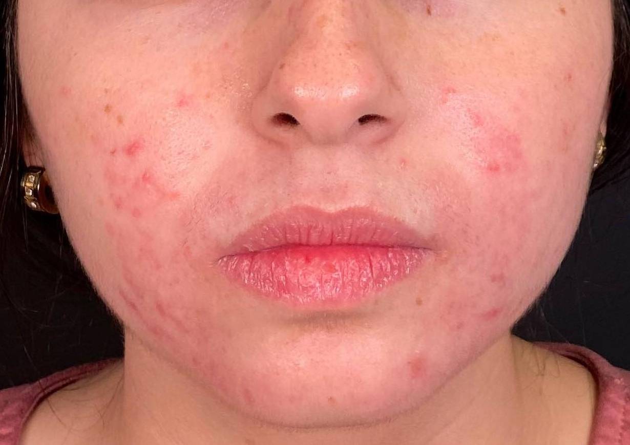 Acne (6 Weeks Spironolactone) Case-19 Before