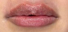 Juvederm (2 Syringes) Case-3 After