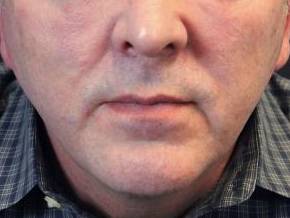 Silhouette InstaLift<sup>™</sup> Before and After Case 8 Before