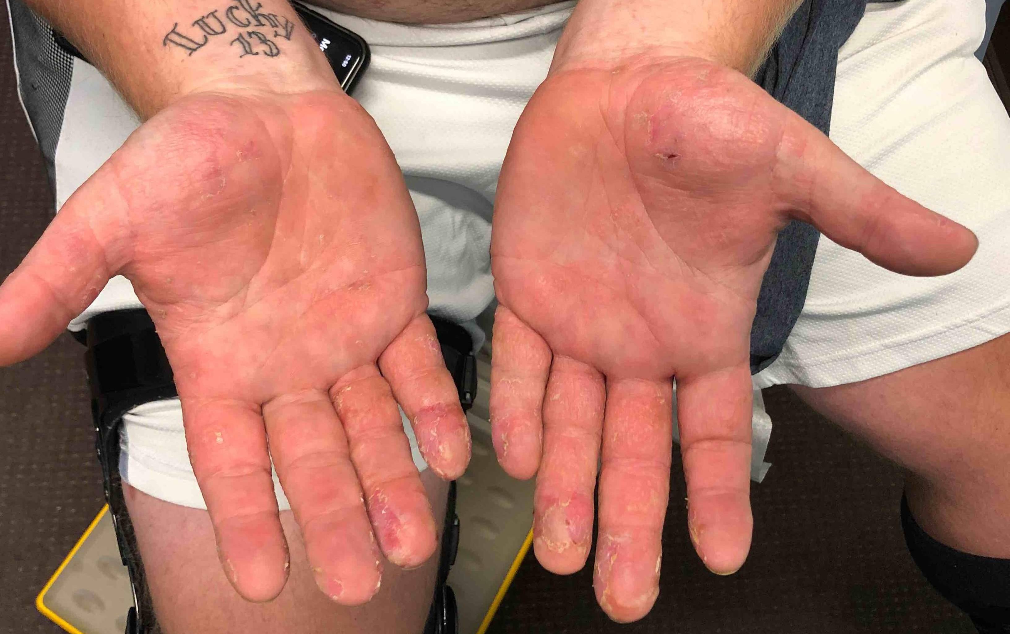 Allergic Contact Dermatitis Case-5 After