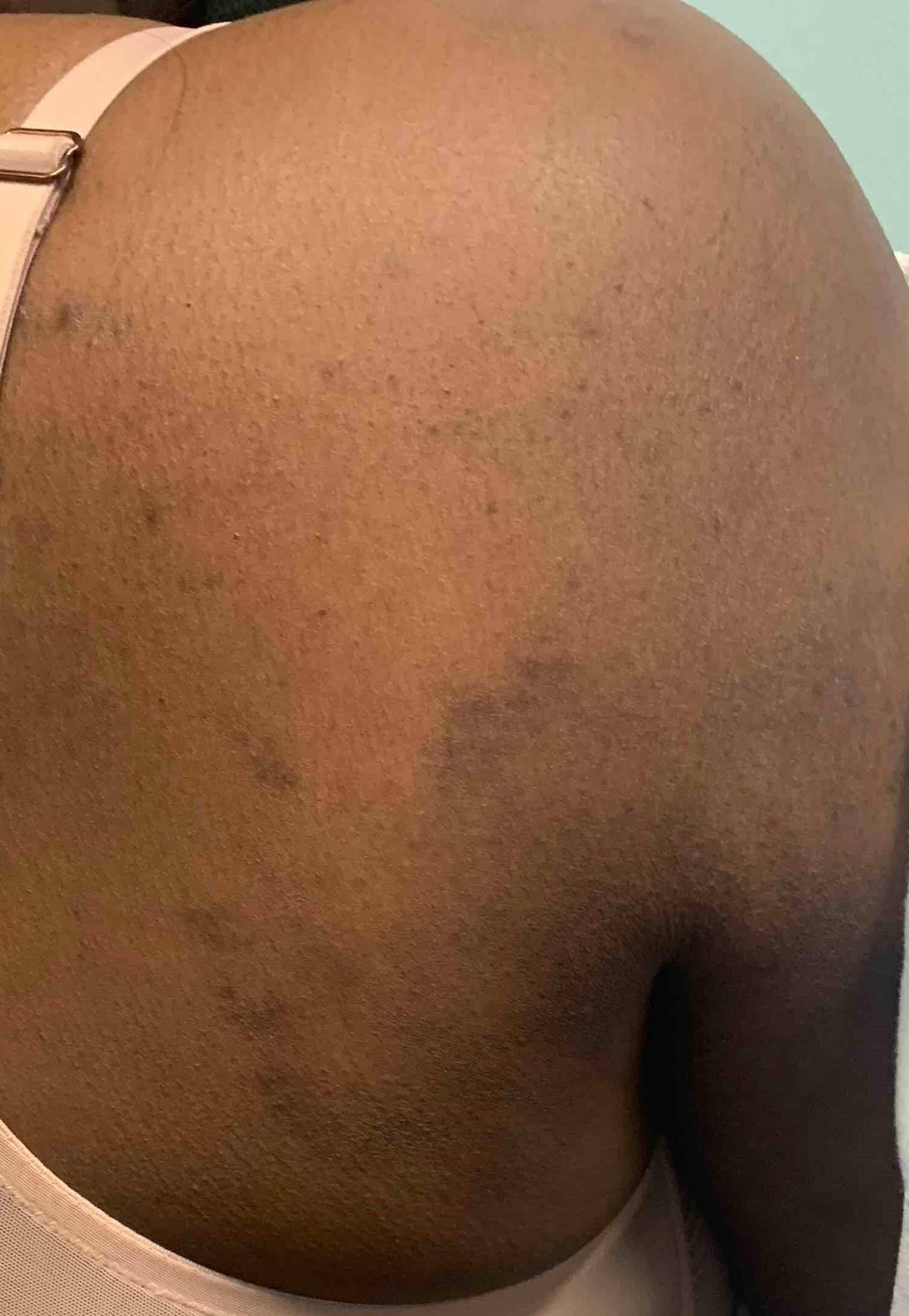 Allergic Contact Dermatitis Case-7 Before