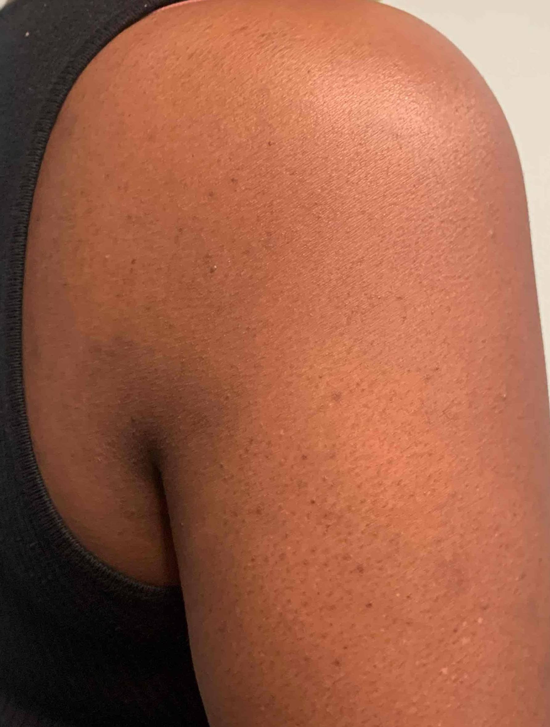 Allergic Contact Dermatitis Case-7 After