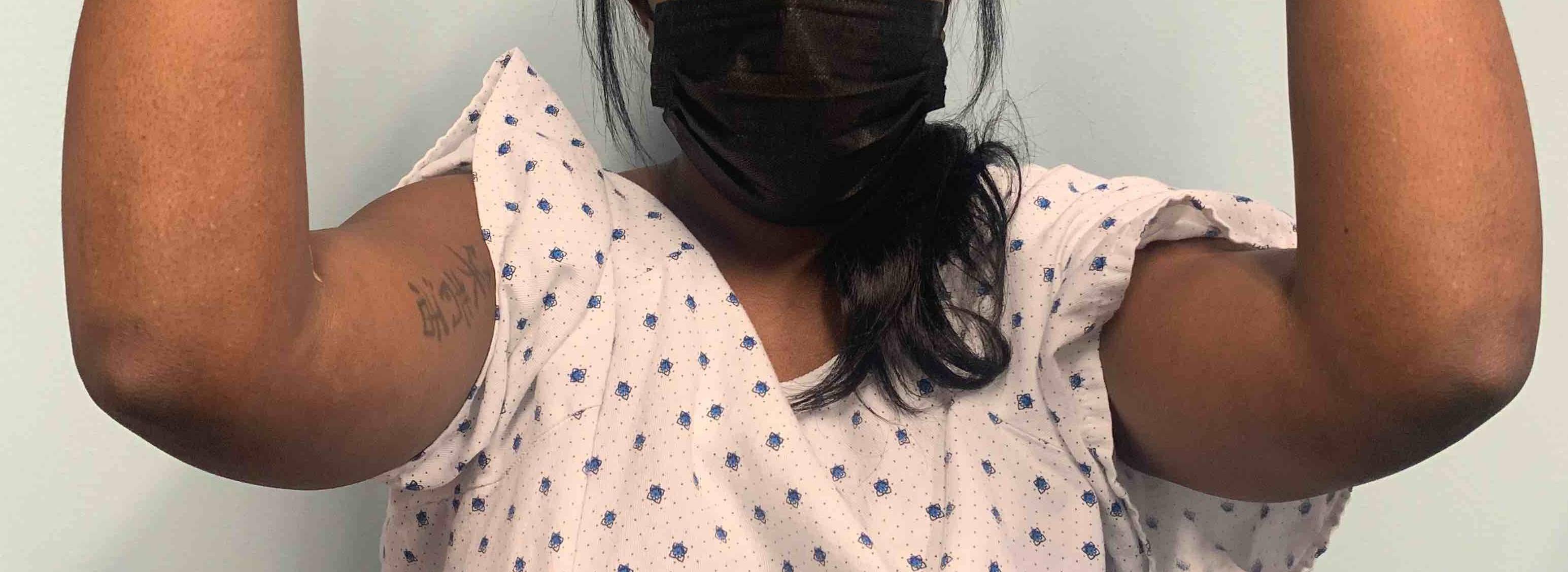 Allergic Contact Dermatitis Case-8 Before