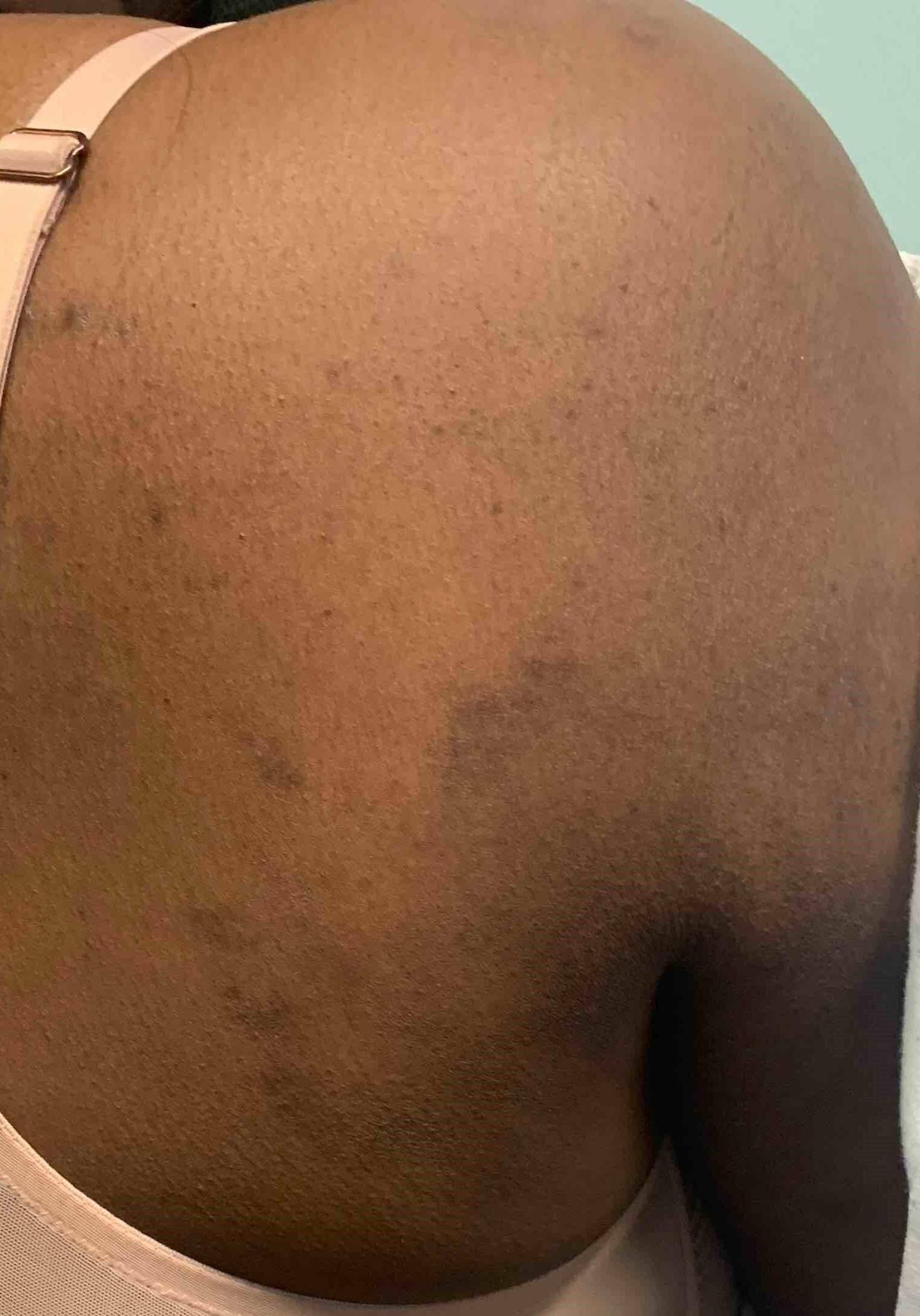 Eczema/ Atopic Dermatitis Case-22 Before