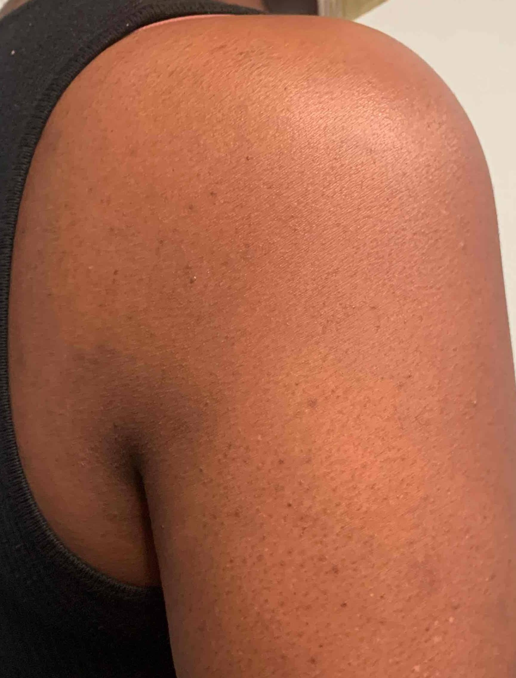 Eczema/ Atopic Dermatitis Case-22 After