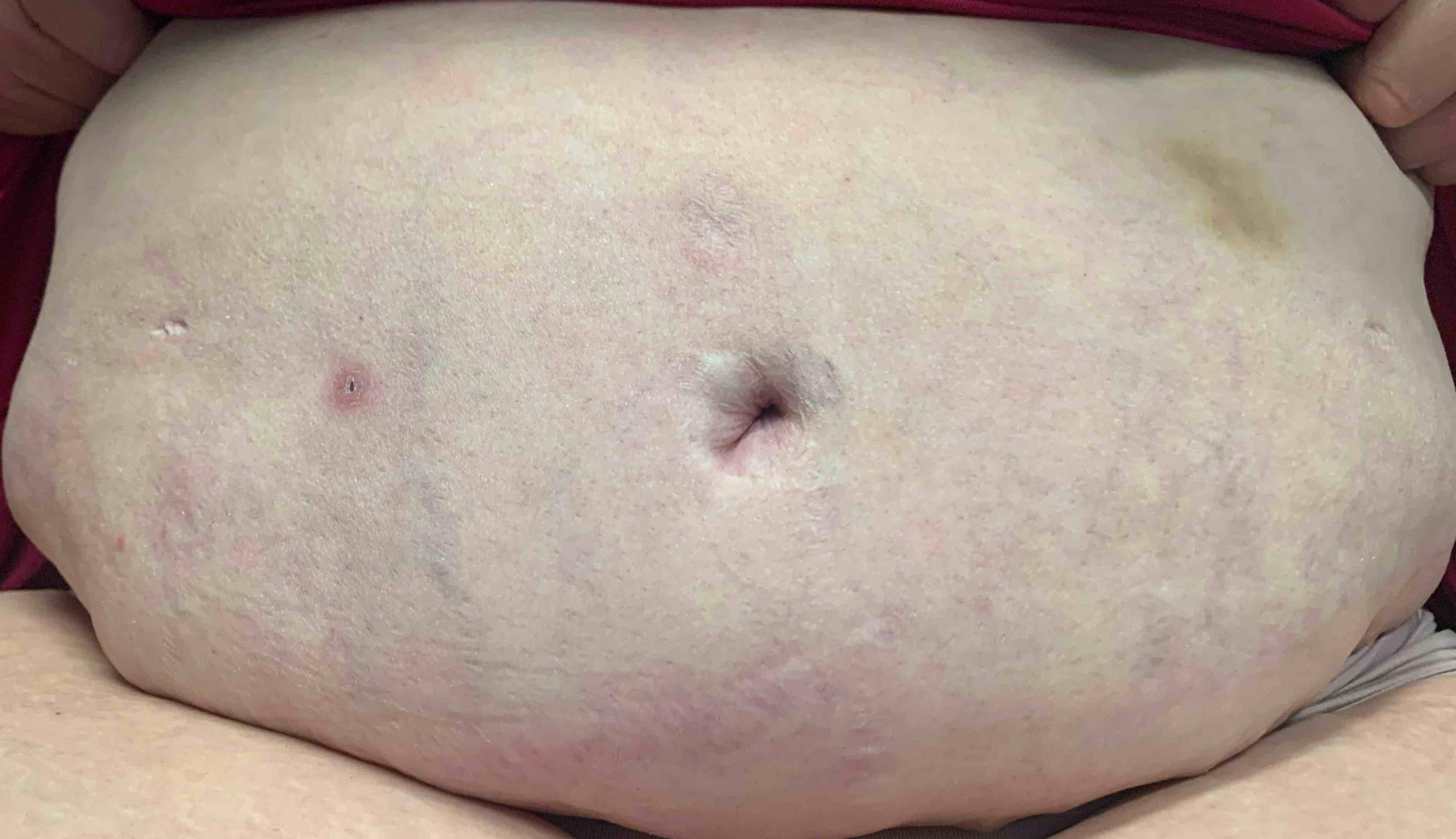 Allergic Contact Dermatitis Case-9 After