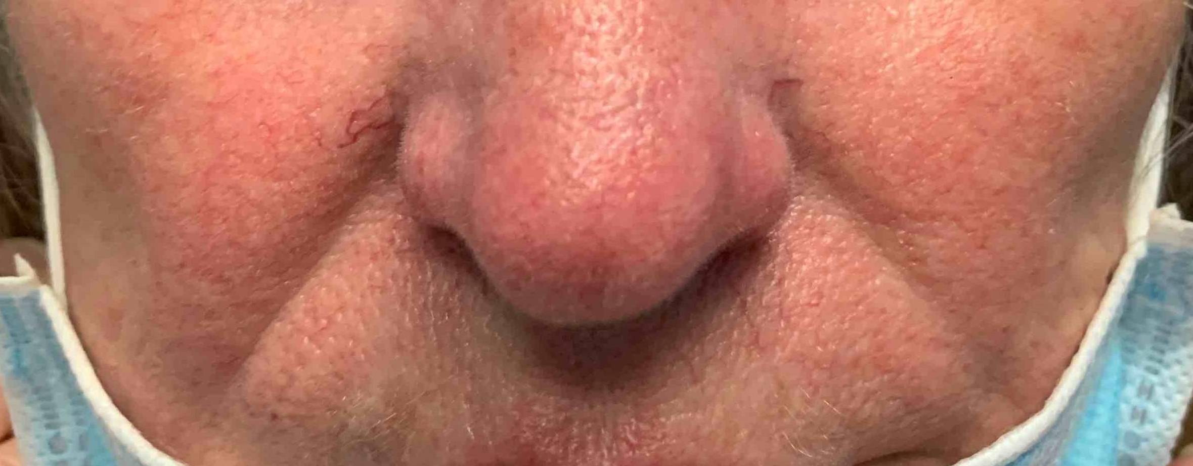 Allergic Contact Dermatitis Case-10 Before