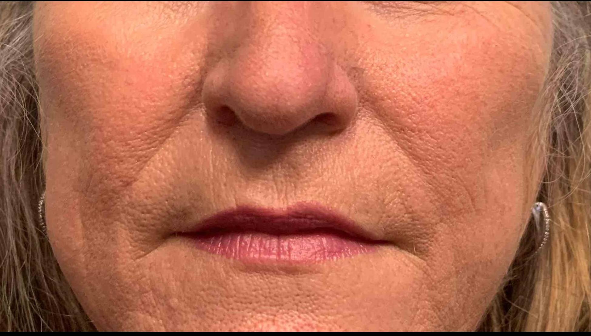 Allergic Contact Dermatitis Case-10 After