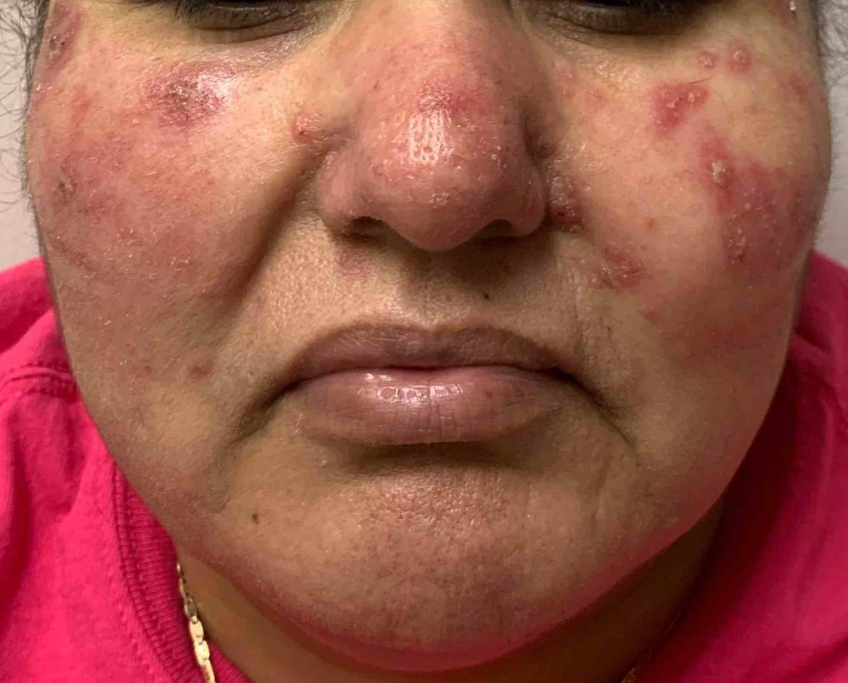 Eczema/ Atopic Dermatitis Case-24 Before