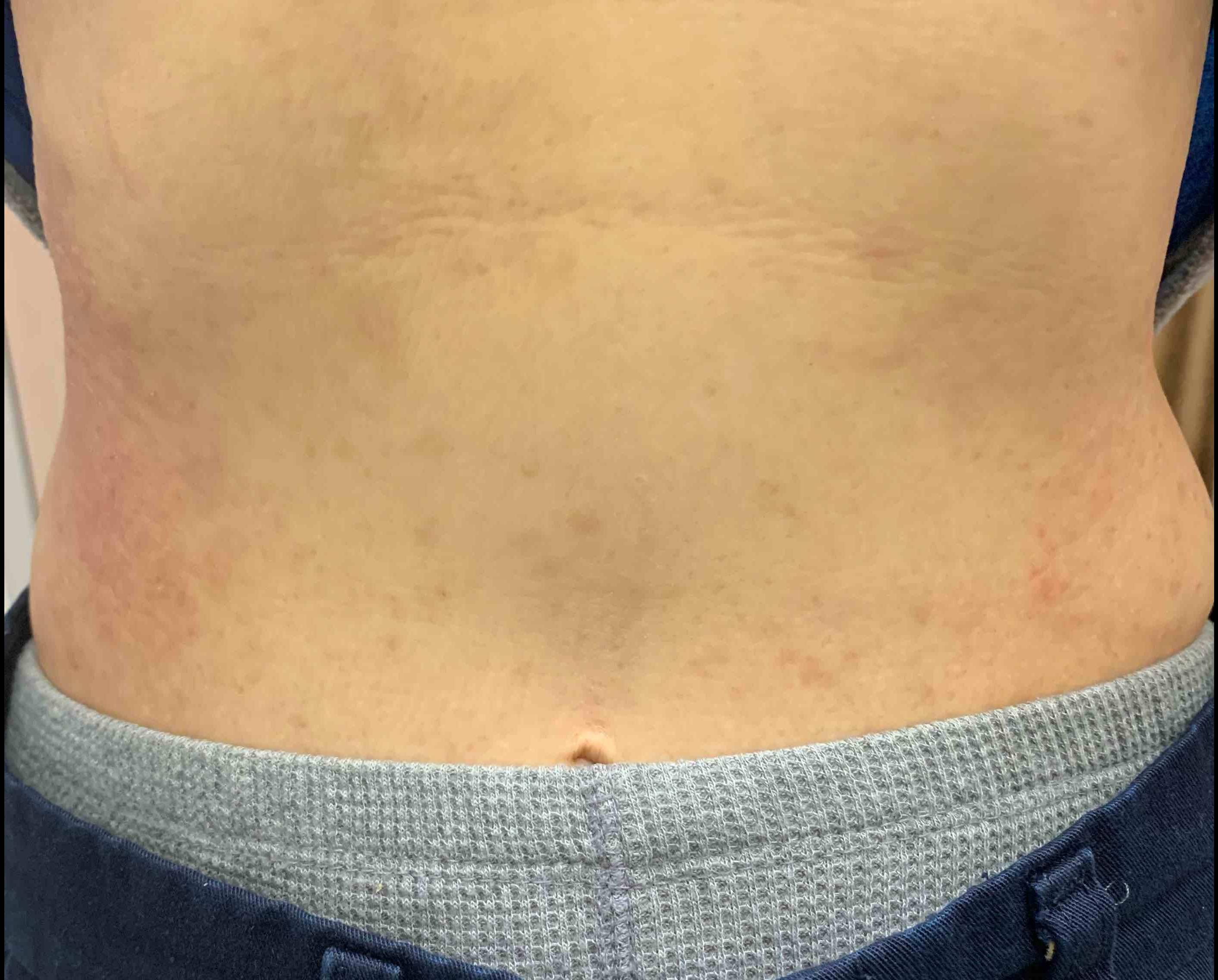 Eczema/Atopic Dermatitis Case-25 Before