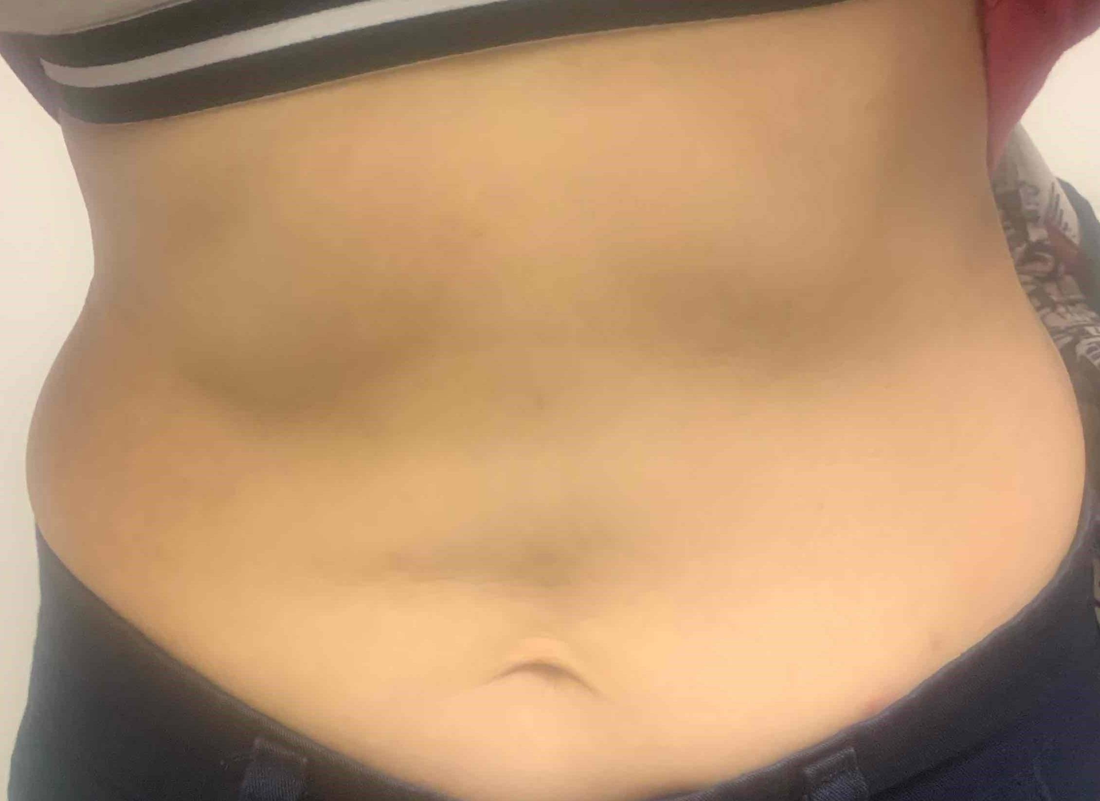 Eczema/Atopic Dermatitis Case-25 After