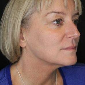 Ultherapy<sup>®</sup> Before and After Case 1 After