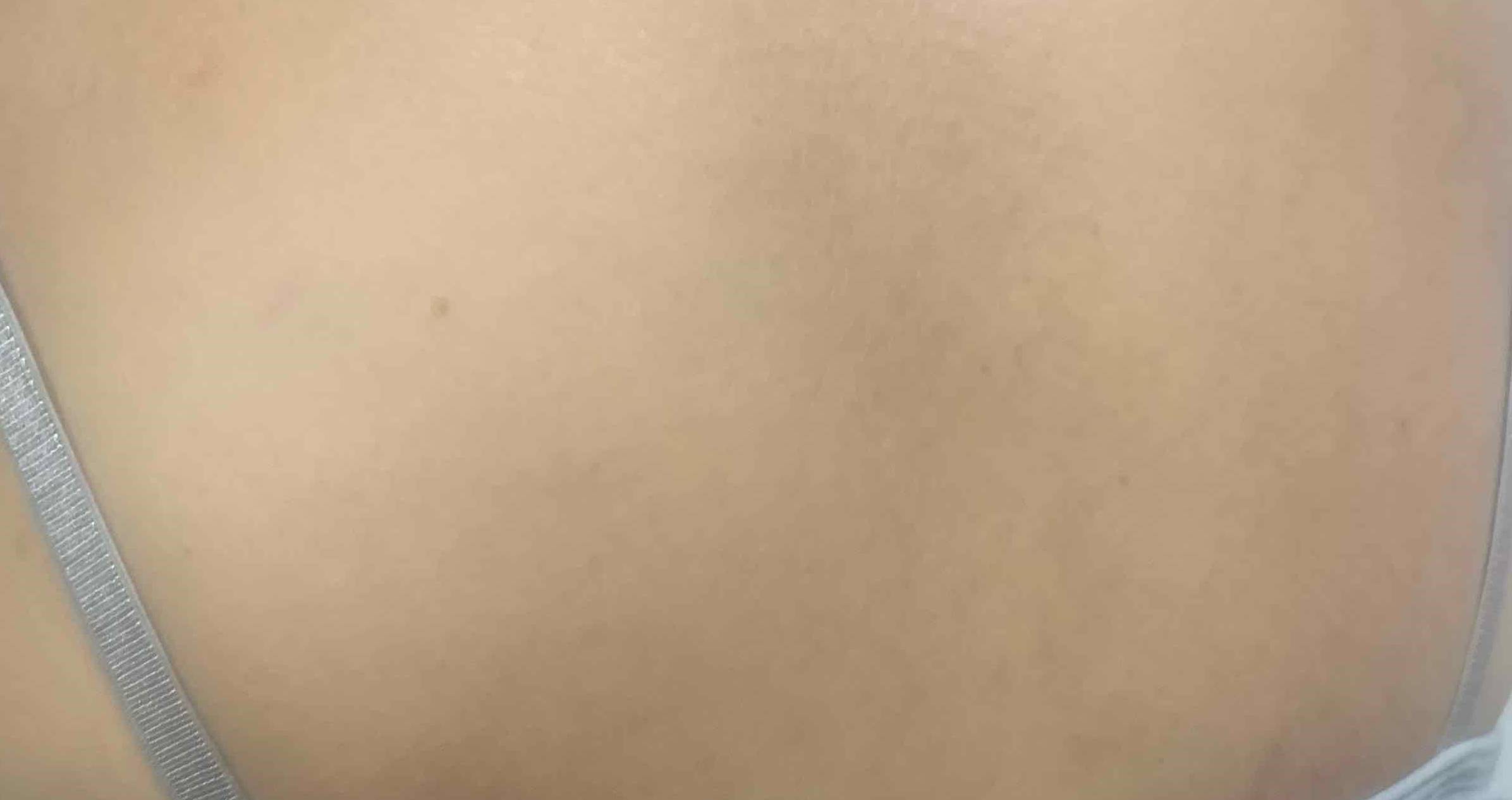 Eczema/ Atopic Dermatitis Case-26 After