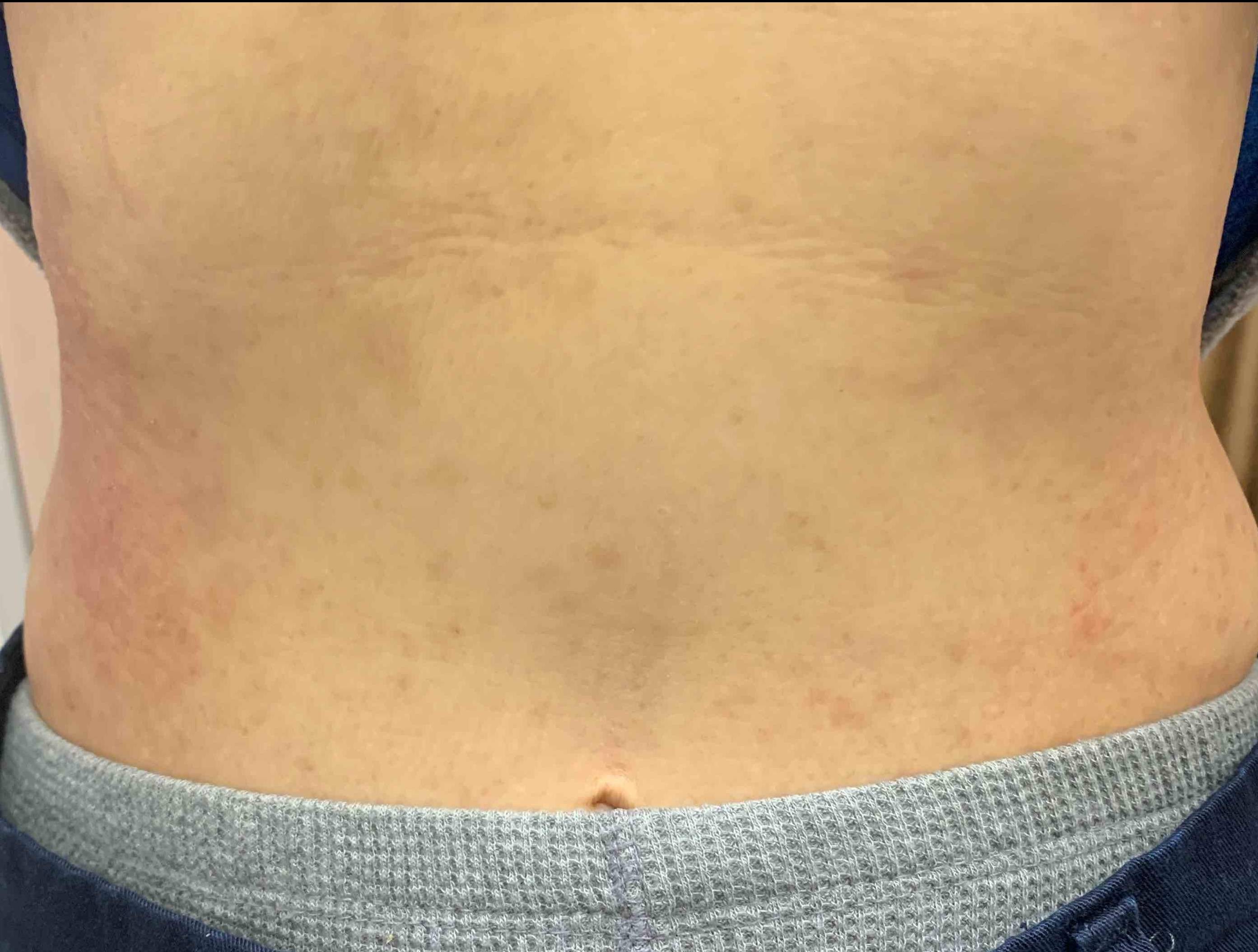 Allergic Contact Dermatitis Case-14 Before