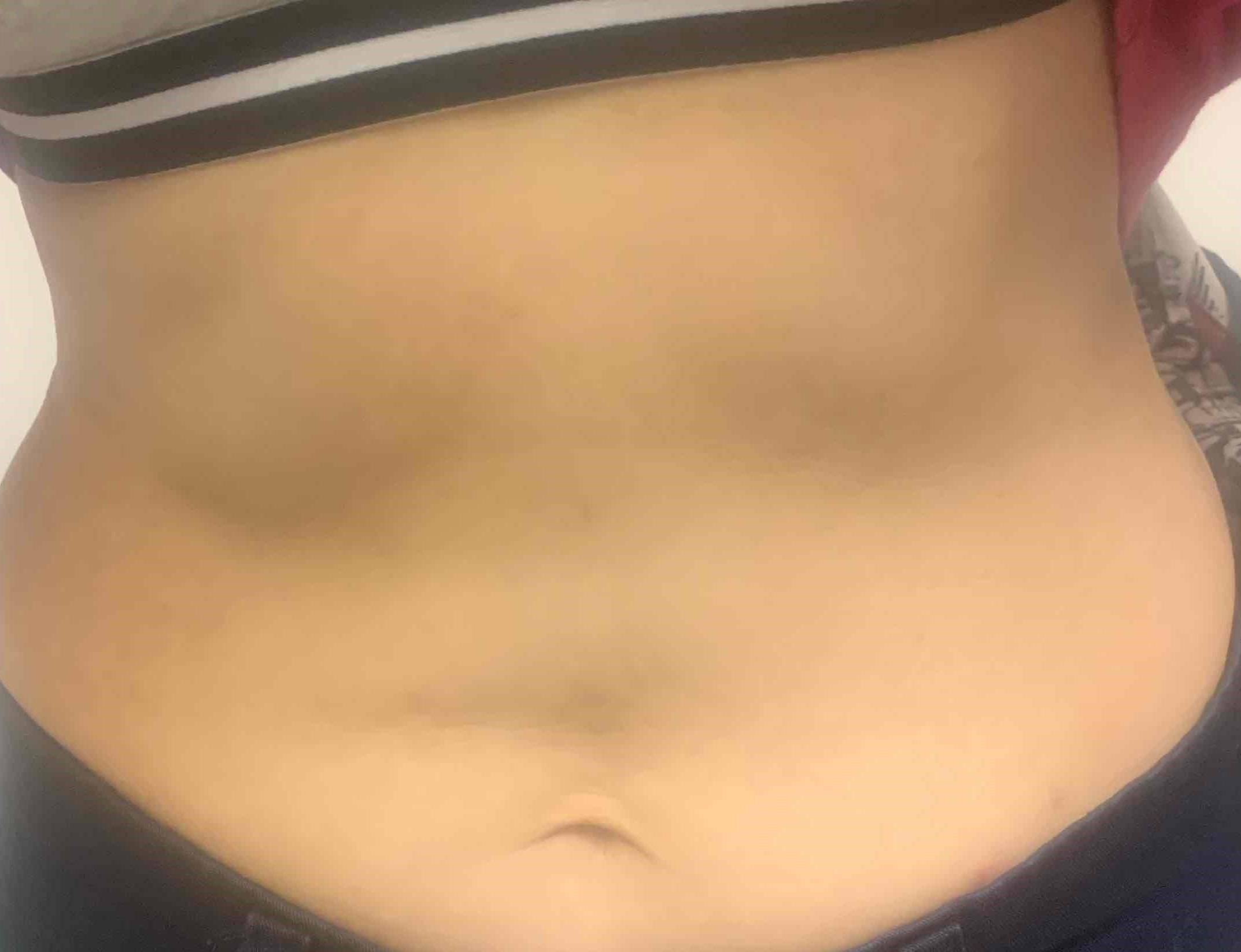 Allergic Contact Dermatitis Case-14 After