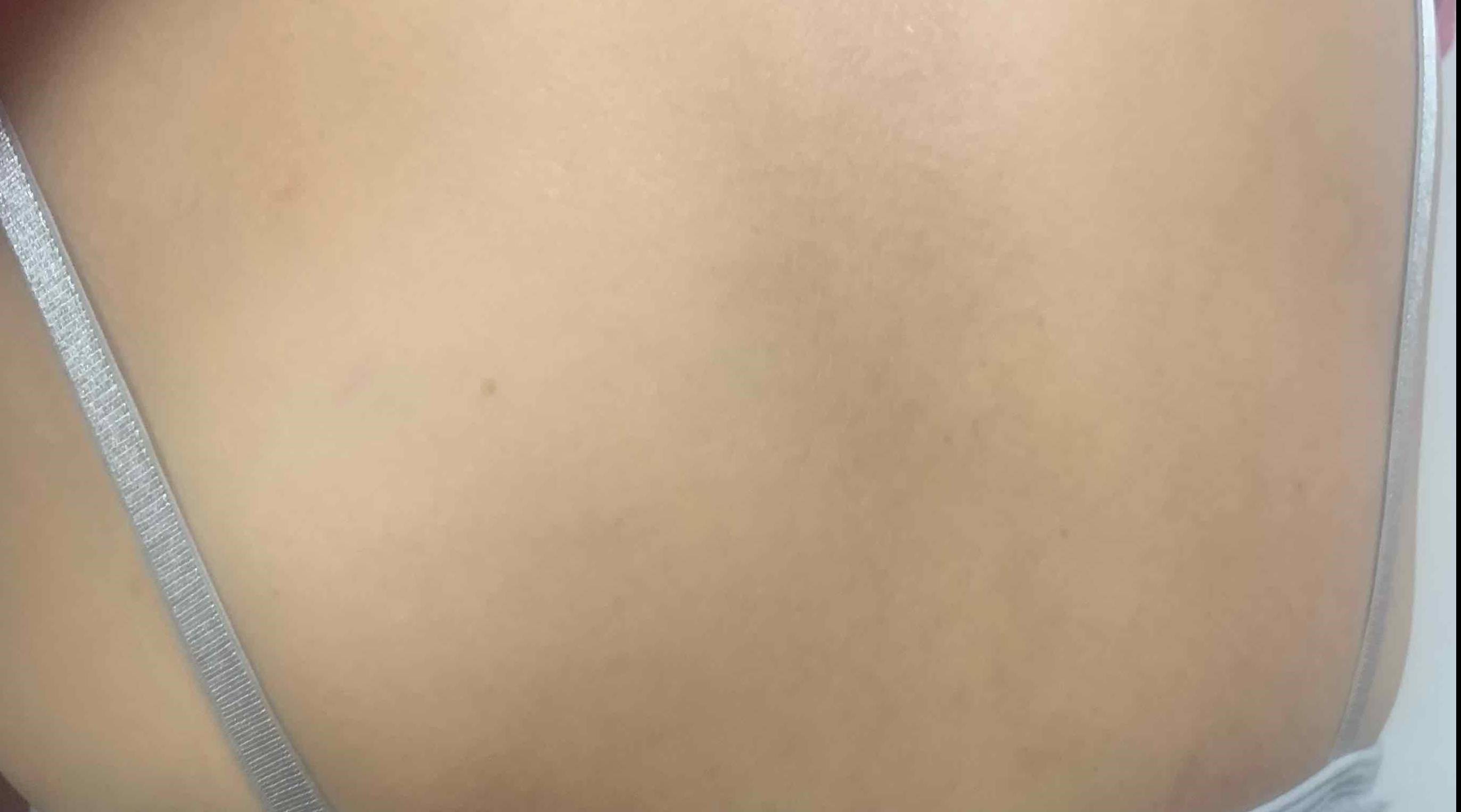 Allergic Contact Dermatitis Case-15 After