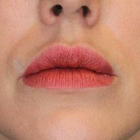 Juvederm (2 Syringes) Case-4 Before