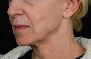 Ultherapy<sup>®</sup> Before and After Case 2 Before