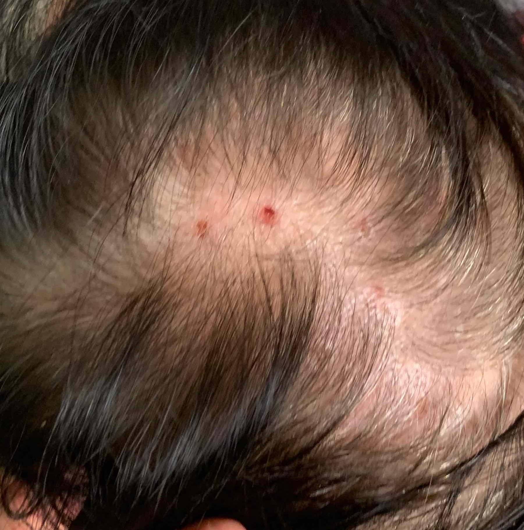 Allergic Contact Dermatitis Case-16 Before