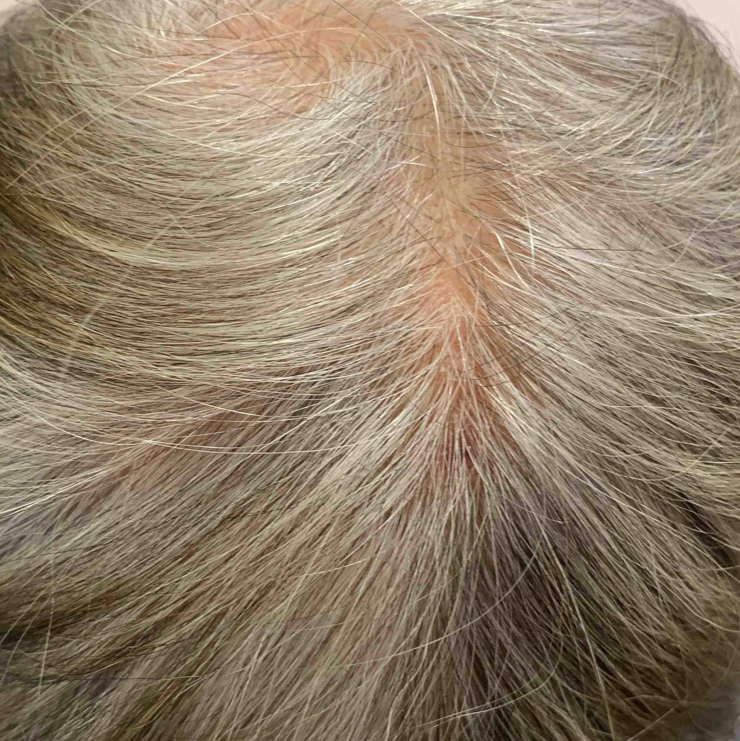 Allergic Contact Dermatitis Case-16 After