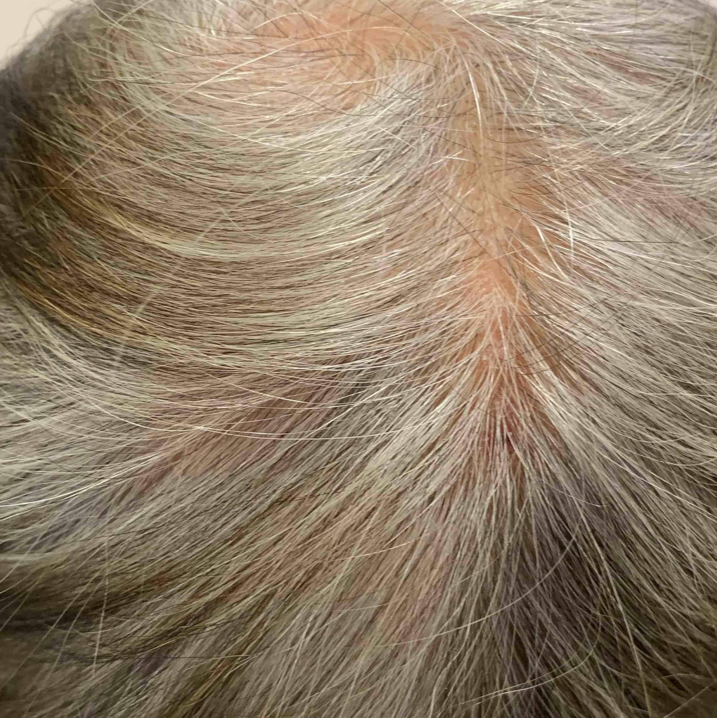 Eczema/ Atopic Dermatitis Case-27 After