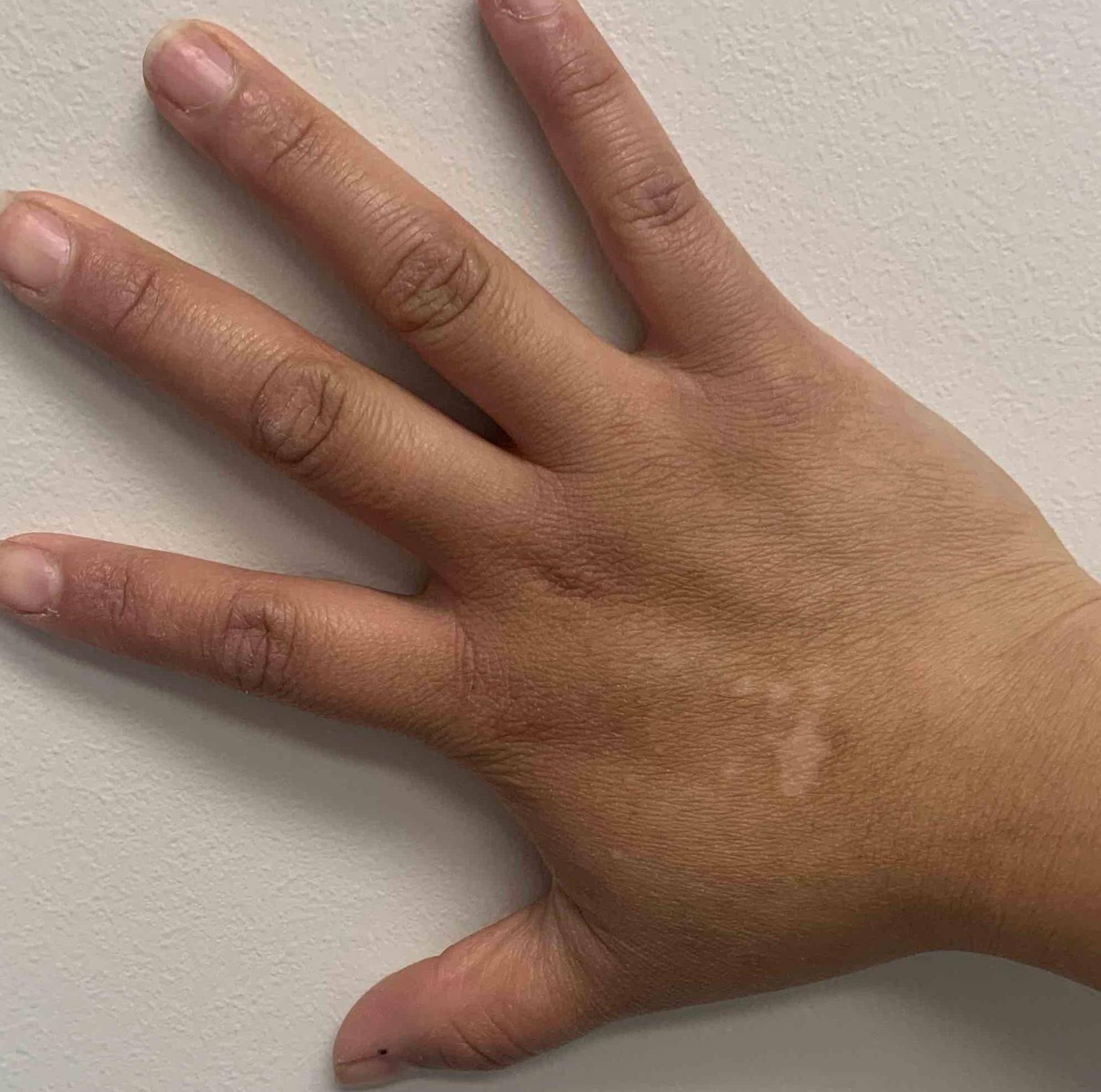 Vitiligo (6 mo Dupixent) Case-3 Before