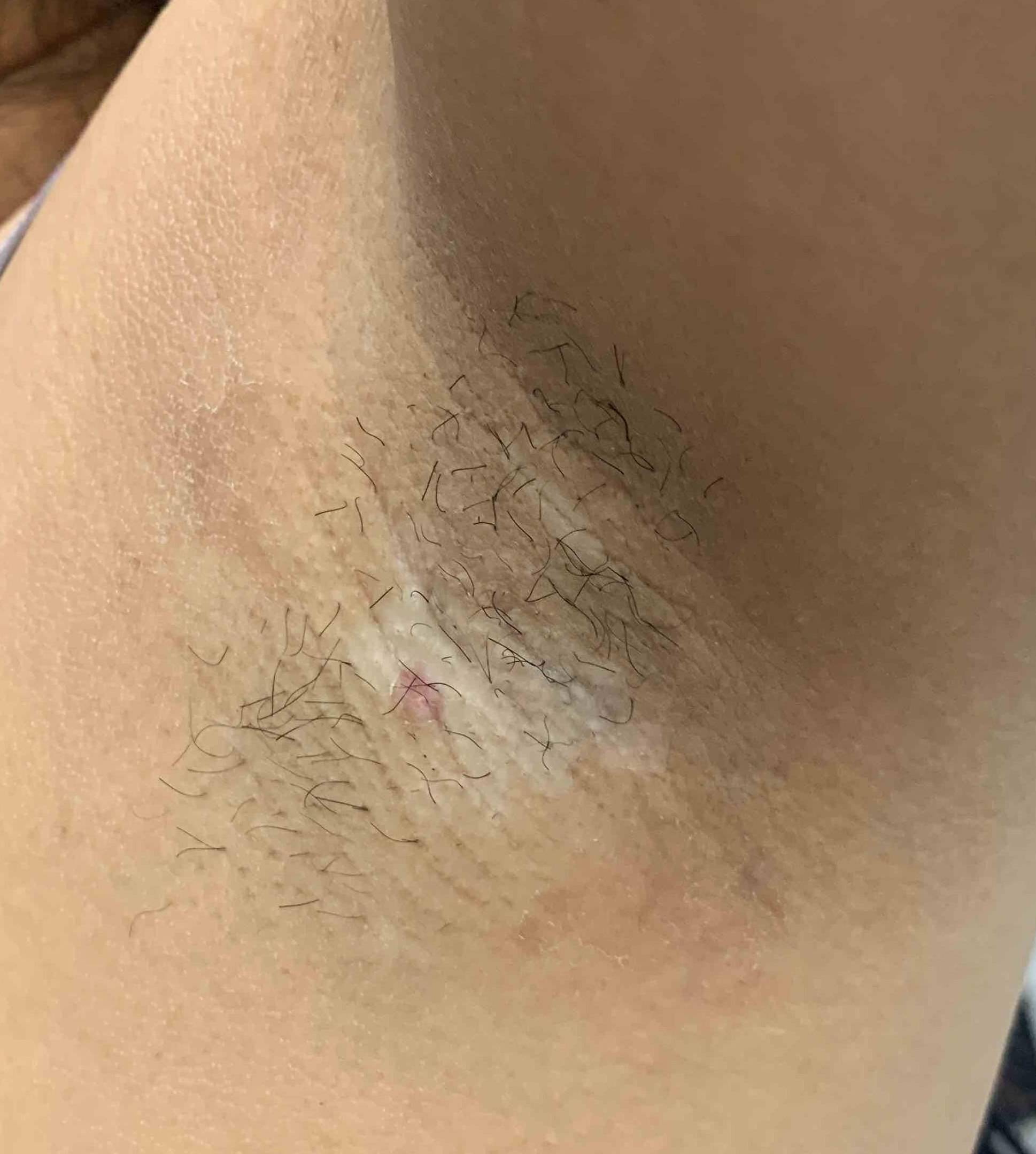 Vitiligo (6 mo Dupixent) Case-4 Before