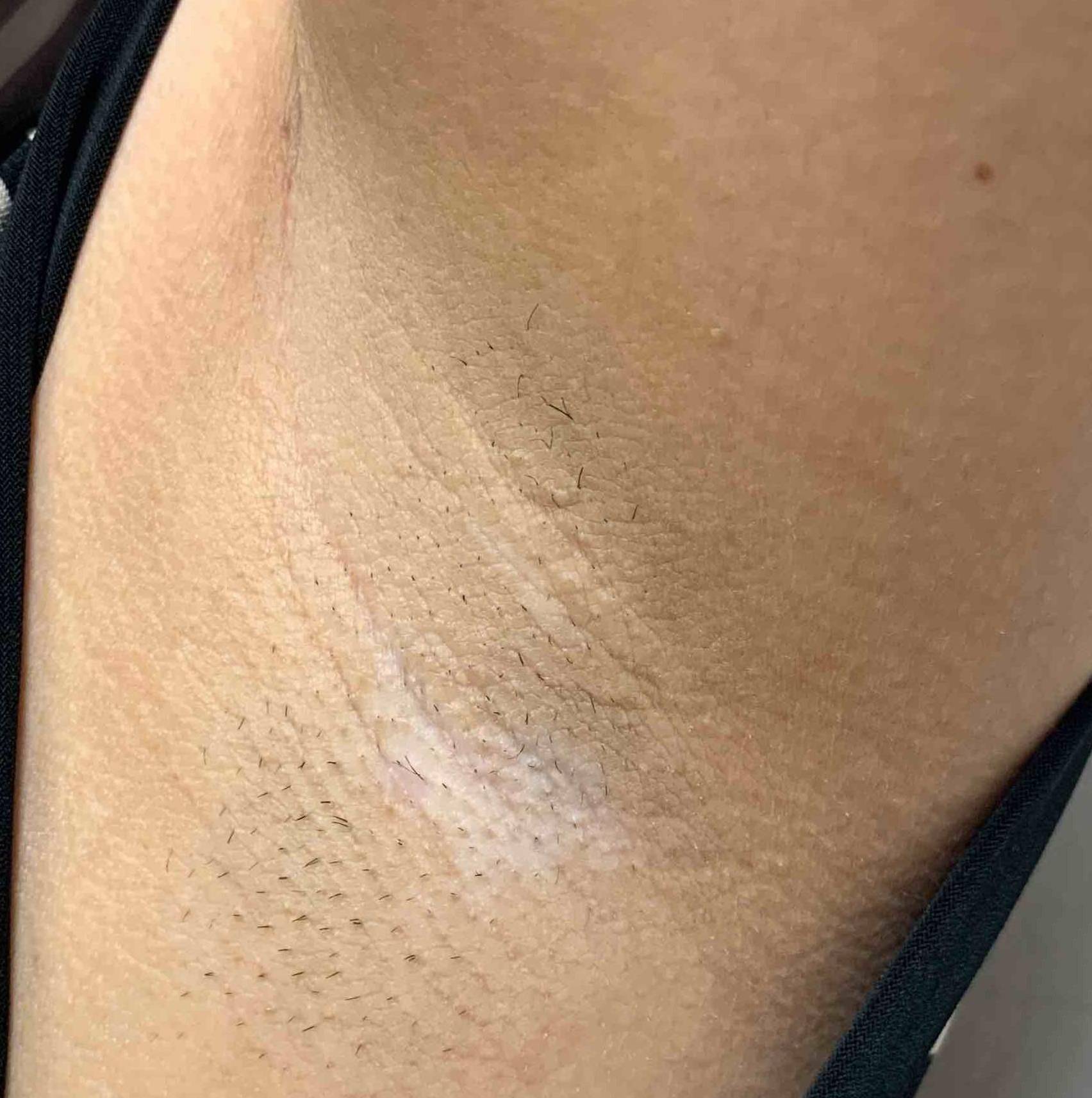 Vitiligo (6 mo Dupixent) Case-4 After