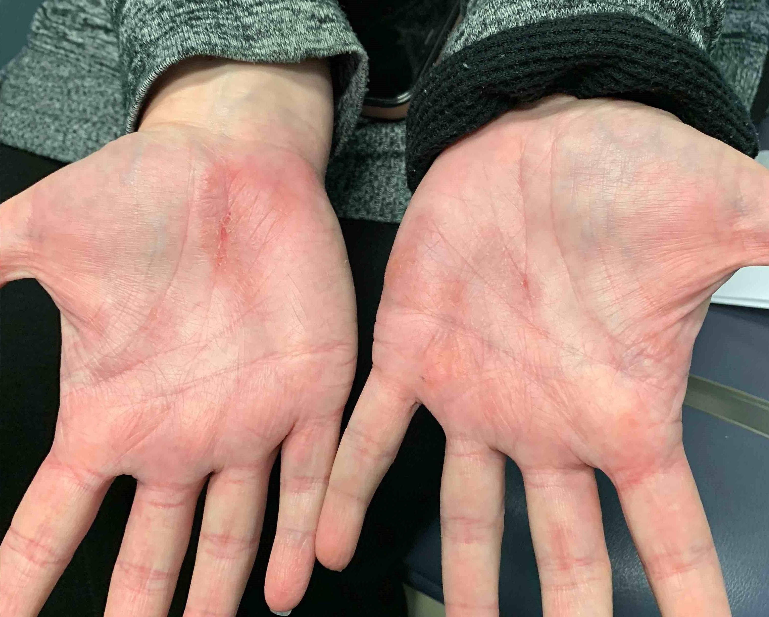 Allergic Contact Dermatitis Case-17 Before