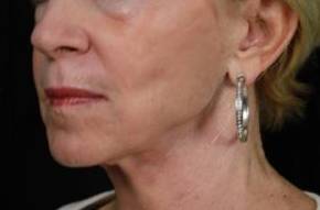 Ultherapy<sup>®</sup> Before and After Case 2 After