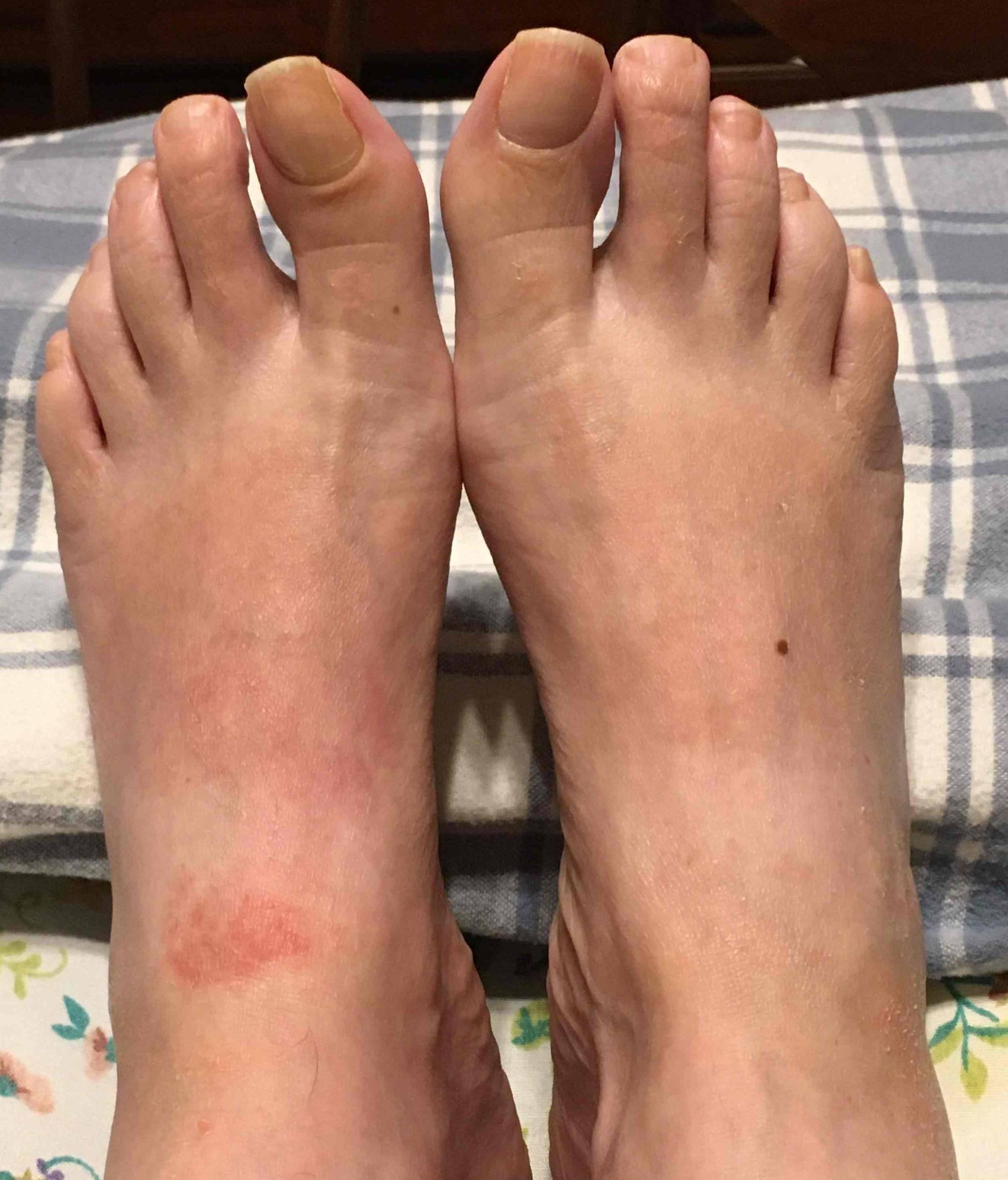 Allergic Contact Dermatitis Case-18 After