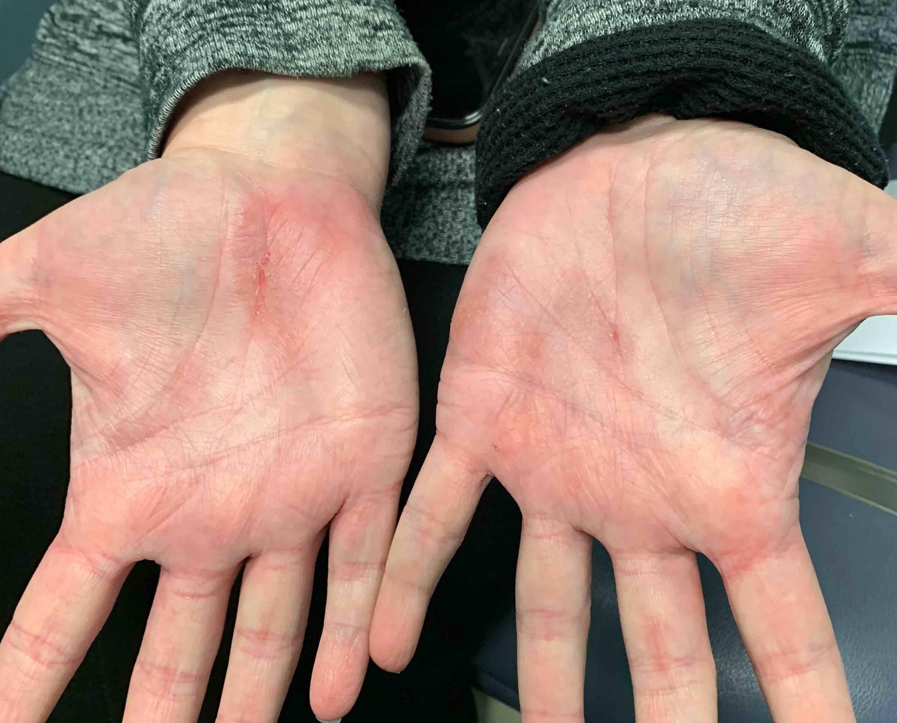 Eczema/ Atopic Dermatitis Case-28 Before