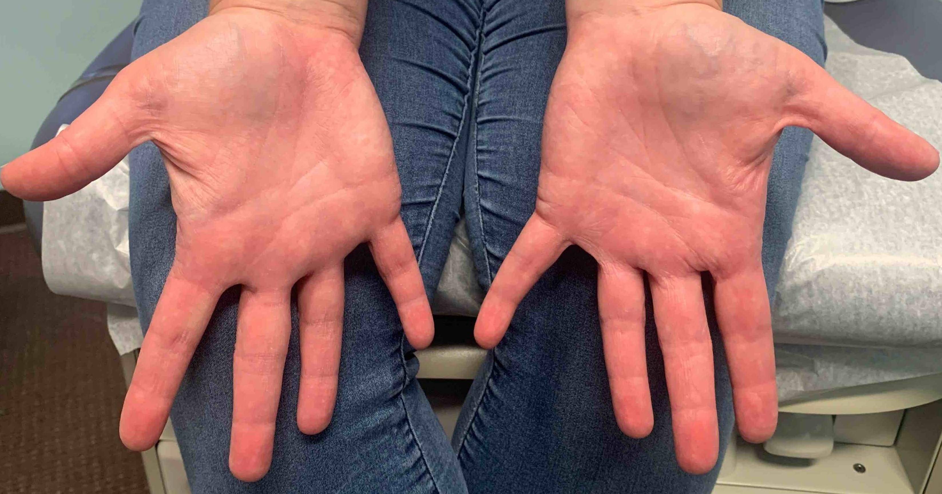 Eczema/ Atopic Dermatitis Case-28 After